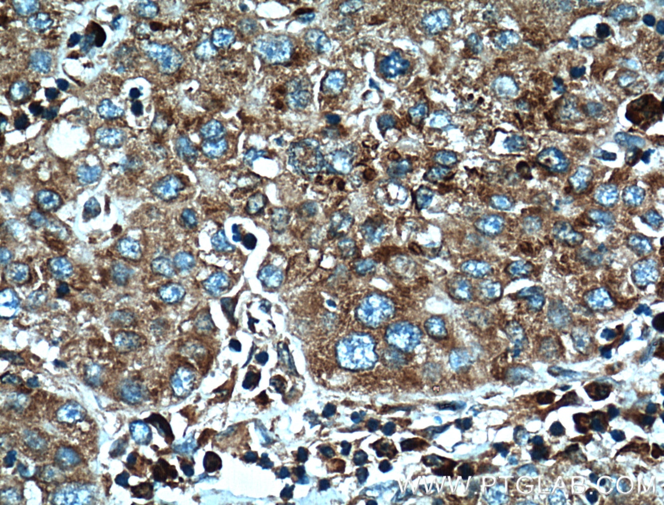 Immunohistochemistry (IHC) staining of human liver cancer tissue using RPL3 Monoclonal antibody (66130-1-Ig)