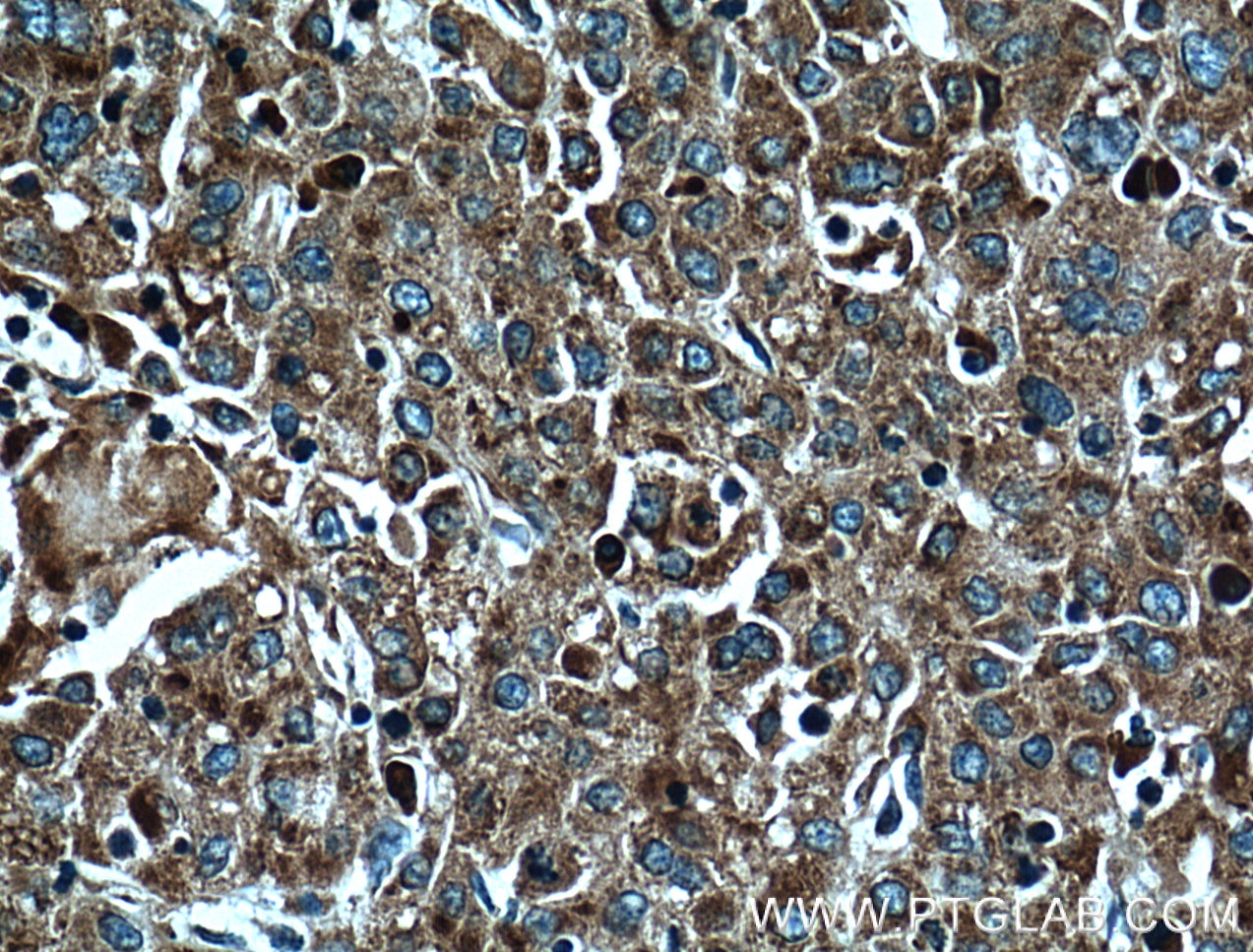 Immunohistochemistry (IHC) staining of human liver cancer tissue using RPL3 Monoclonal antibody (66130-1-Ig)