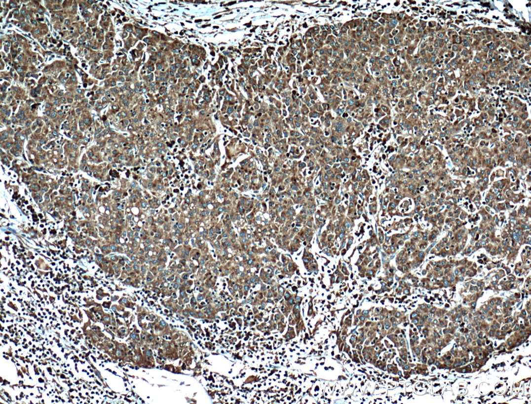 Immunohistochemistry (IHC) staining of human liver cancer tissue using RPL3 Monoclonal antibody (66130-1-Ig)