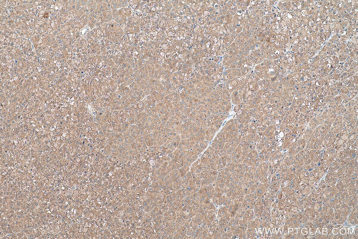 Immunohistochemistry (IHC) staining of human liver cancer tissue using RPL35 Polyclonal antibody (14826-1-AP)