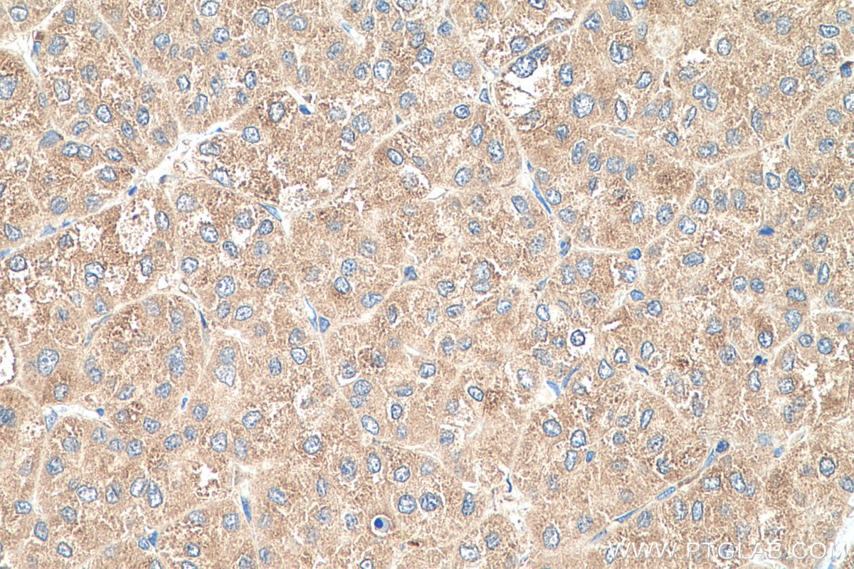 Immunohistochemistry (IHC) staining of human liver cancer tissue using RPL35 Polyclonal antibody (14826-1-AP)
