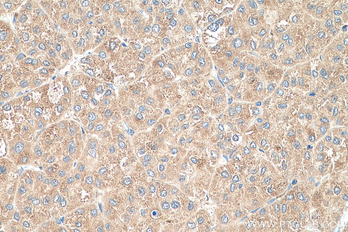 Immunohistochemistry (IHC) staining of human liver cancer tissue using RPL35 Polyclonal antibody (14826-1-AP)