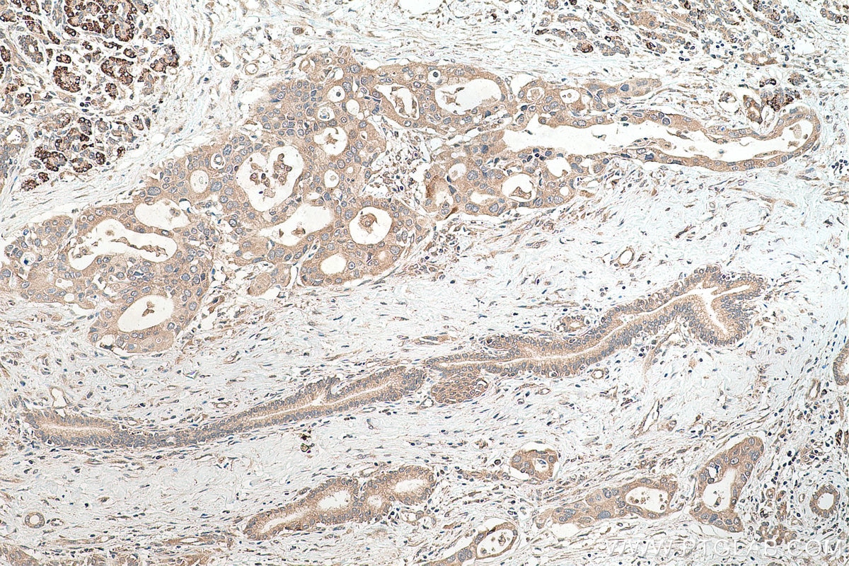 Immunohistochemistry (IHC) staining of human pancreas cancer tissue using RPL35 Polyclonal antibody (14826-1-AP)