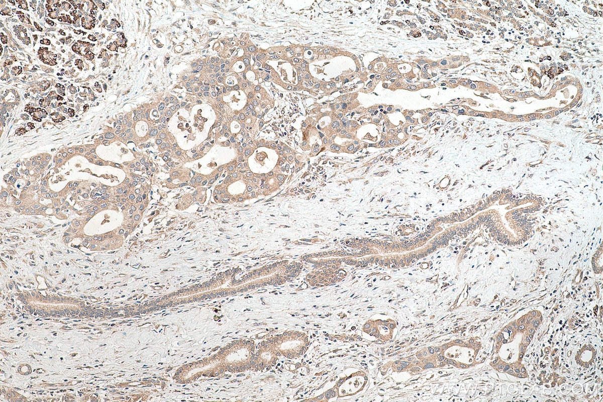 IHC staining of human pancreas cancer using 14826-1-AP