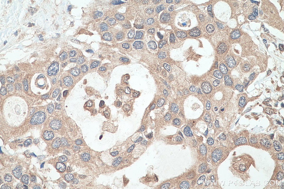 Immunohistochemistry (IHC) staining of human pancreas cancer tissue using RPL35 Polyclonal antibody (14826-1-AP)