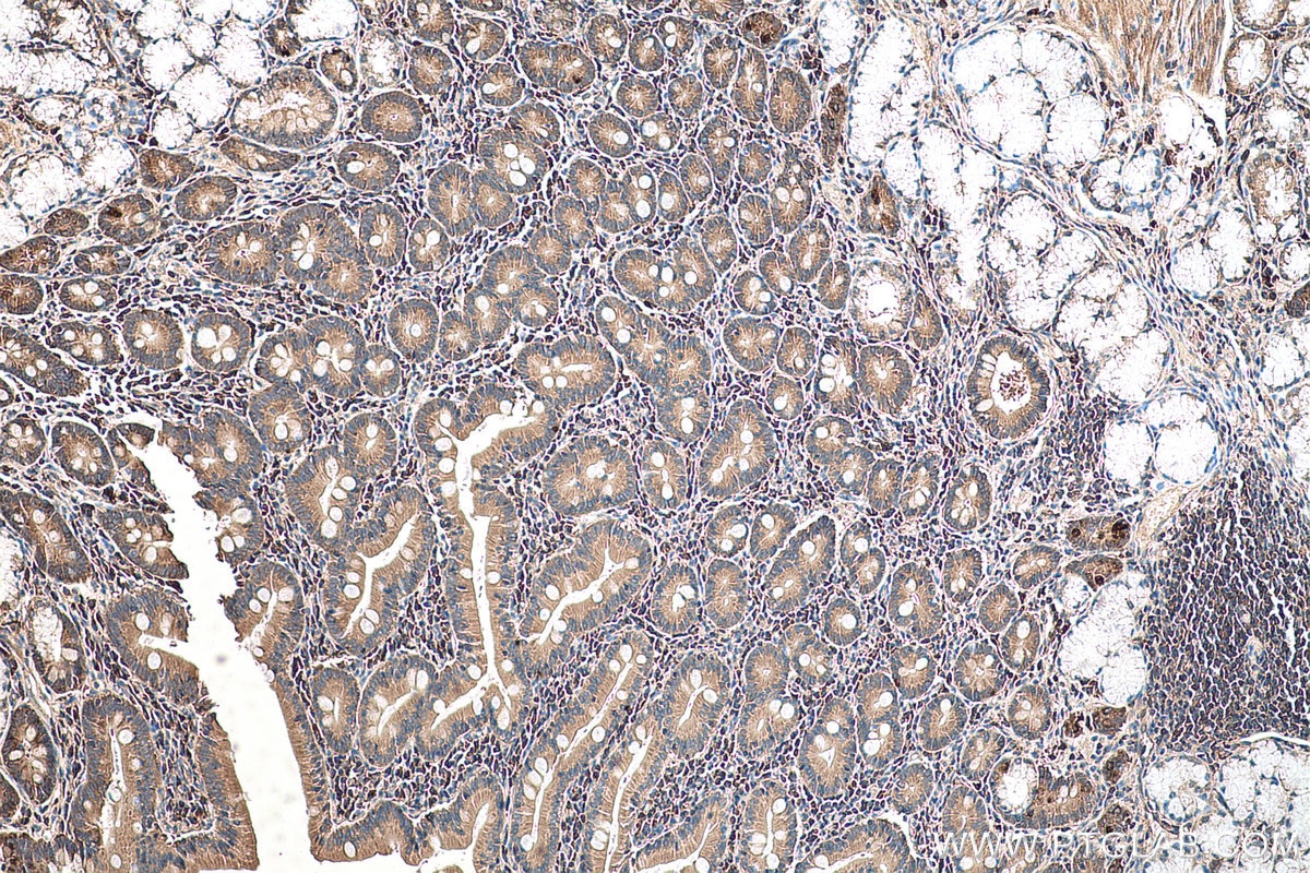 Immunohistochemistry (IHC) staining of human stomach cancer tissue using RPL35 Polyclonal antibody (14826-1-AP)
