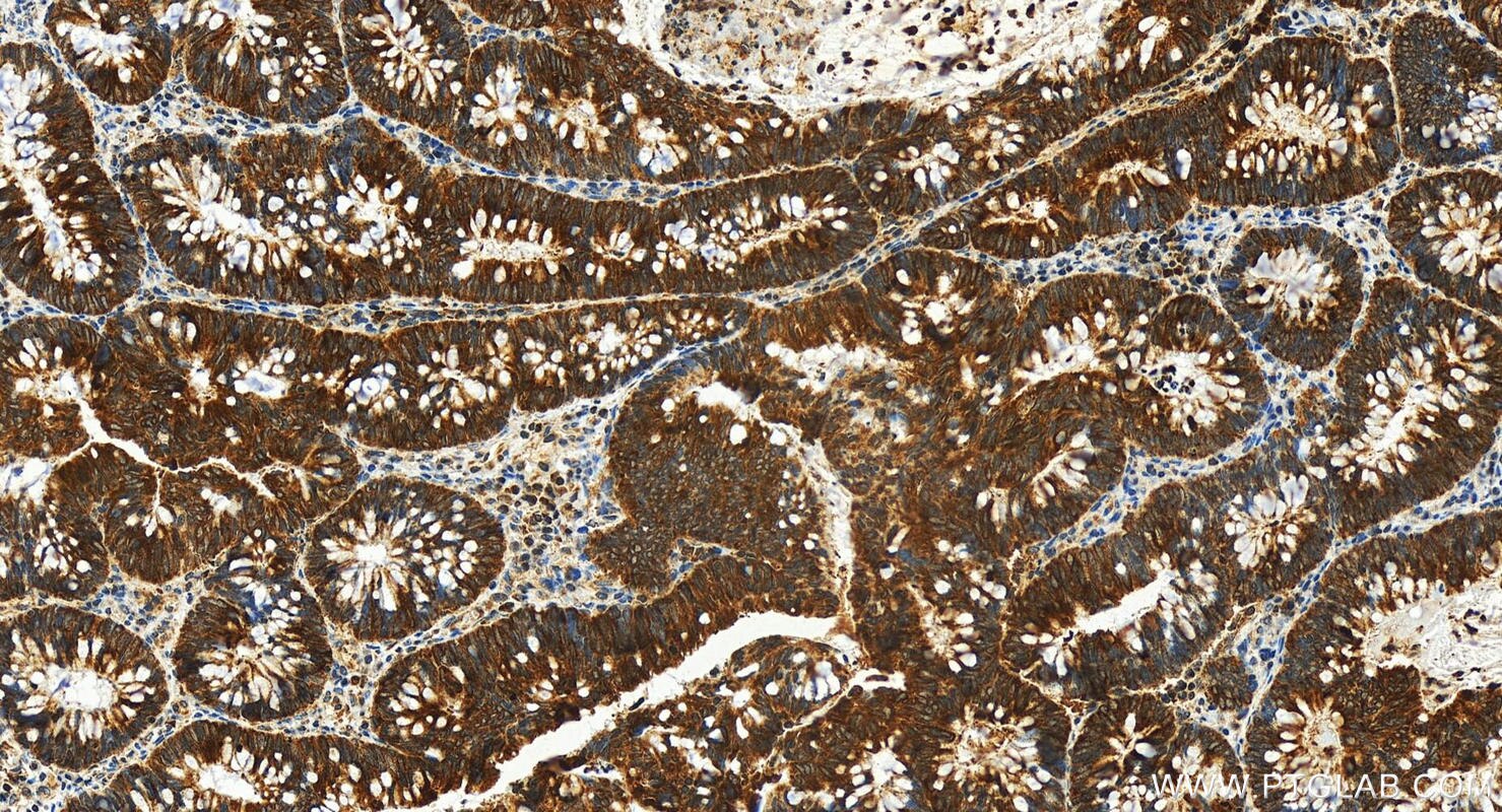 Immunohistochemistry (IHC) staining of human colon cancer tissue using RPL36A Polyclonal antibody (15185-1-AP)