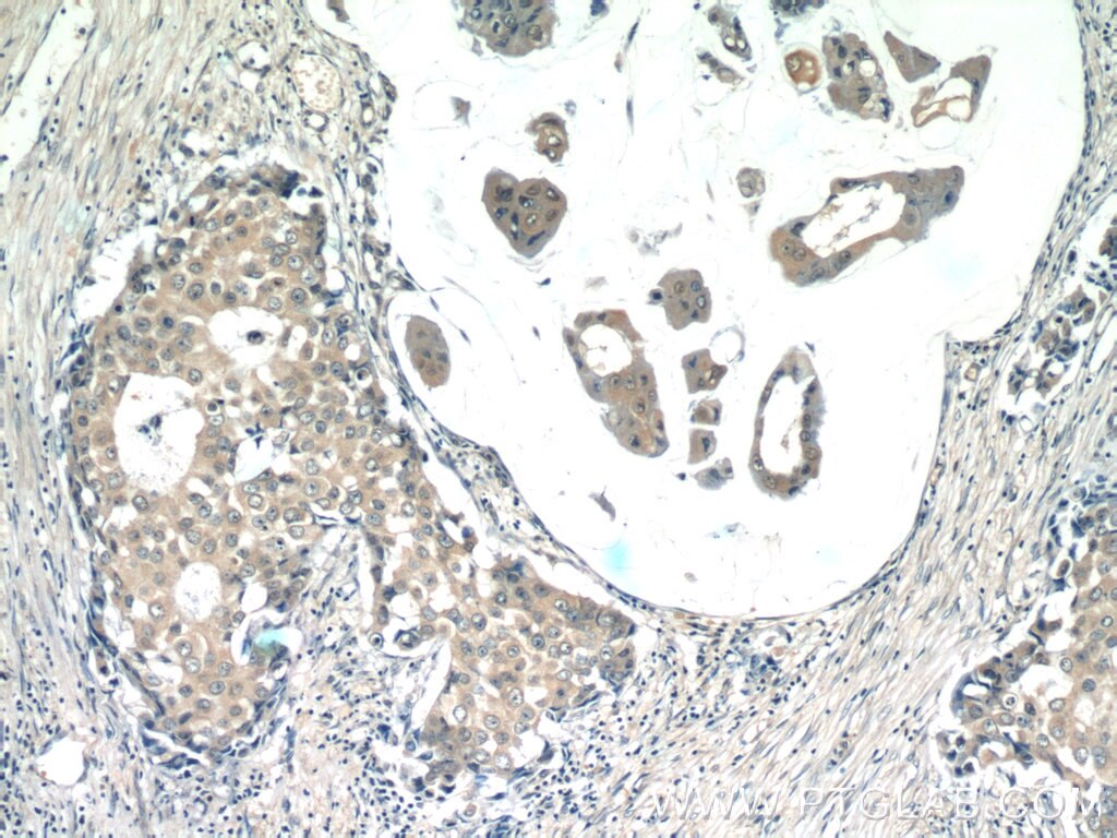Immunohistochemistry (IHC) staining of human breast cancer tissue using RPL36AL Polyclonal antibody (15535-1-AP)