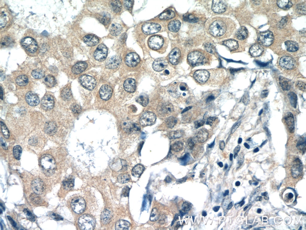 Immunohistochemistry (IHC) staining of human breast cancer tissue using RPL36AL Polyclonal antibody (15535-1-AP)