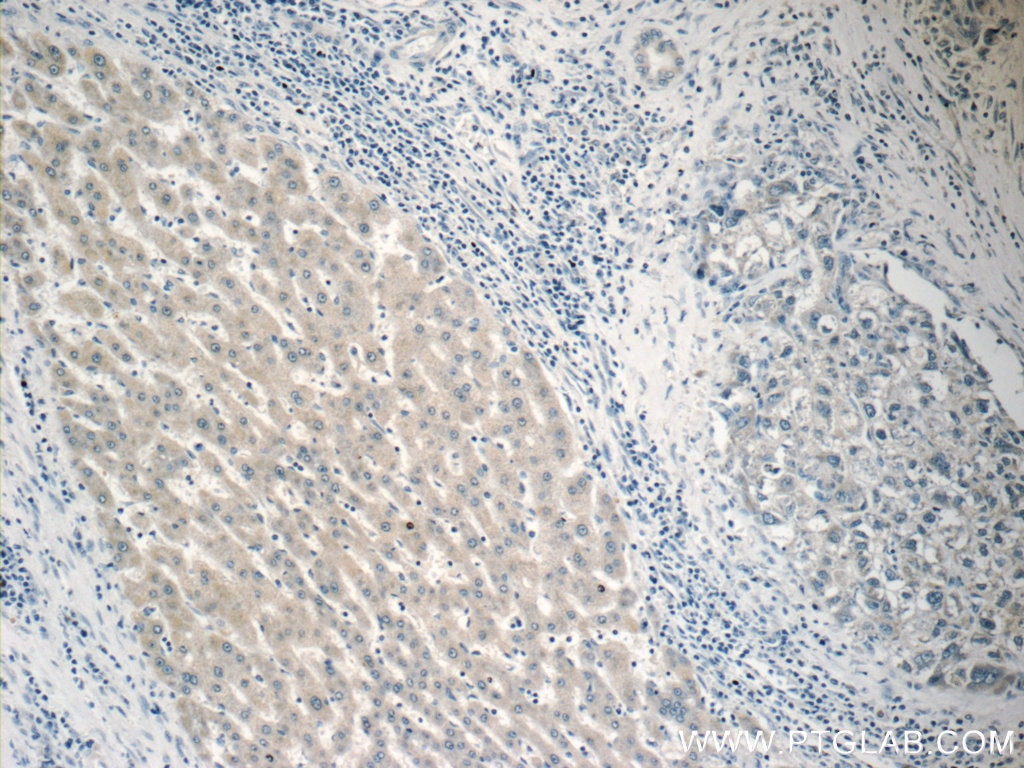 Immunohistochemistry (IHC) staining of human liver cancer tissue using RPL36AL Polyclonal antibody (15535-1-AP)