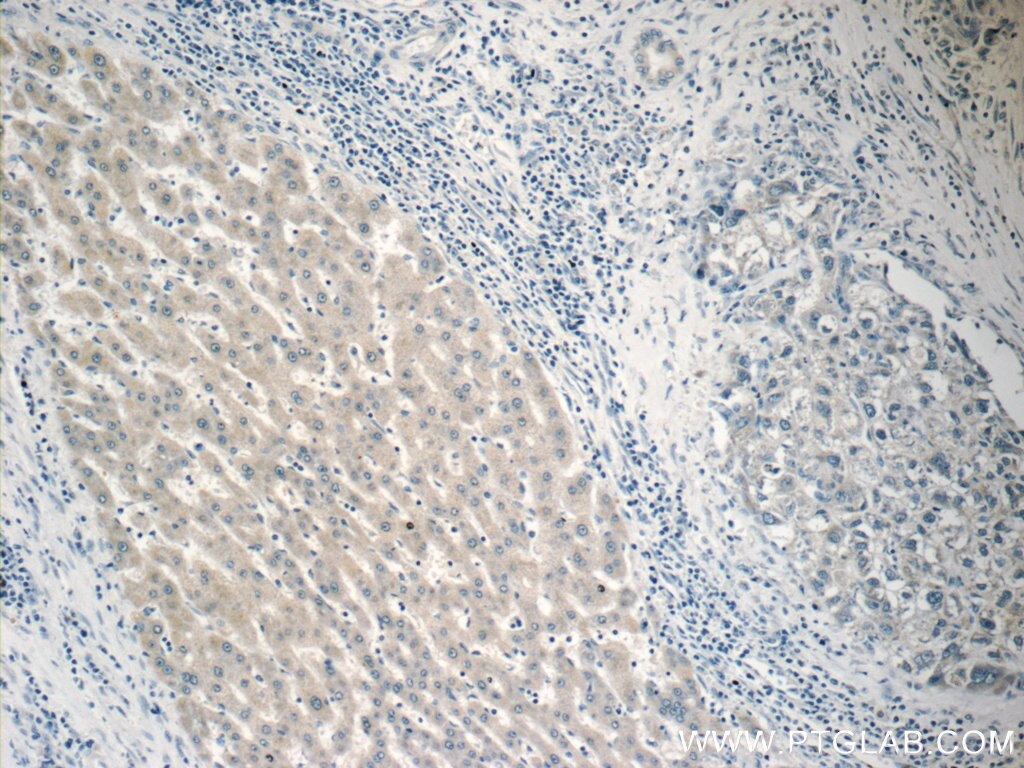 IHC staining of human liver cancer using 15535-1-AP