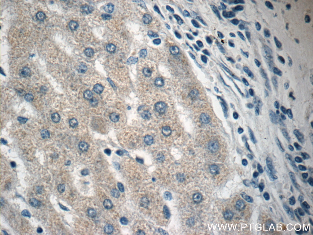 Immunohistochemistry (IHC) staining of human liver cancer tissue using RPL36AL Polyclonal antibody (15535-1-AP)