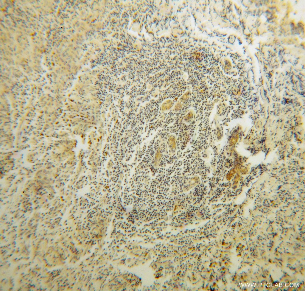 Immunohistochemistry (IHC) staining of human breast cancer tissue using RPL37A Polyclonal antibody (14660-1-AP)