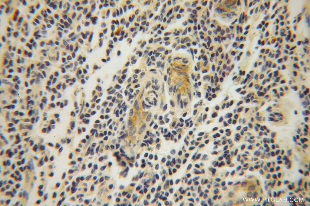 Immunohistochemistry (IHC) staining of human breast cancer tissue using RPL37A Polyclonal antibody (14660-1-AP)