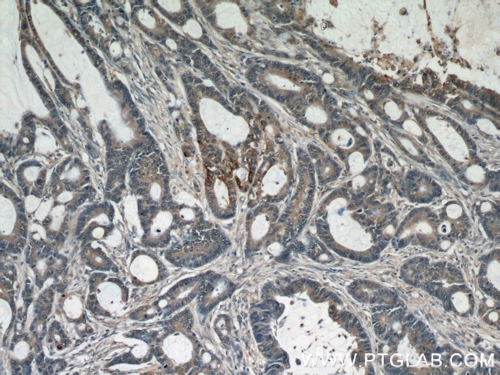 Immunohistochemistry (IHC) staining of human colon cancer tissue using RPL38 Polyclonal antibody (15055-1-AP)
