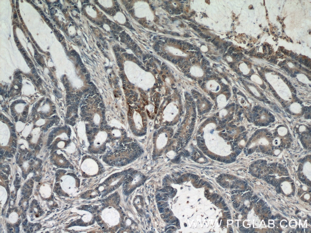 IHC staining of human colon cancer using 15055-1-AP