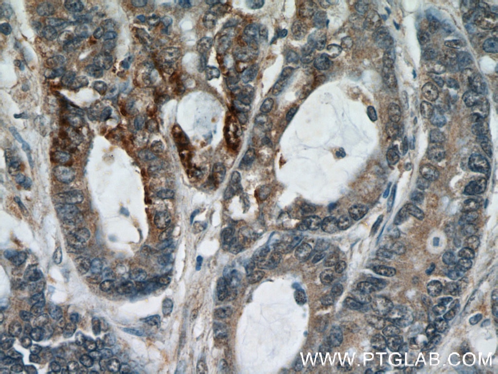 Immunohistochemistry (IHC) staining of human colon cancer tissue using RPL38 Polyclonal antibody (15055-1-AP)