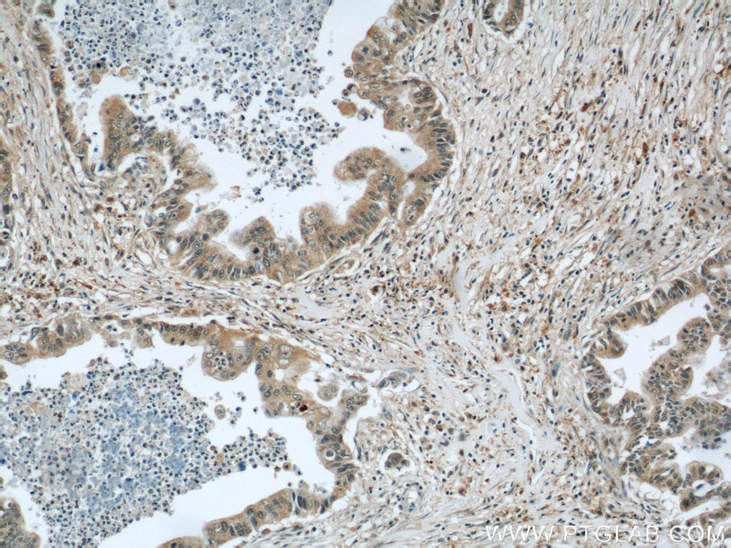 IHC staining of human pancreas cancer using 15055-1-AP