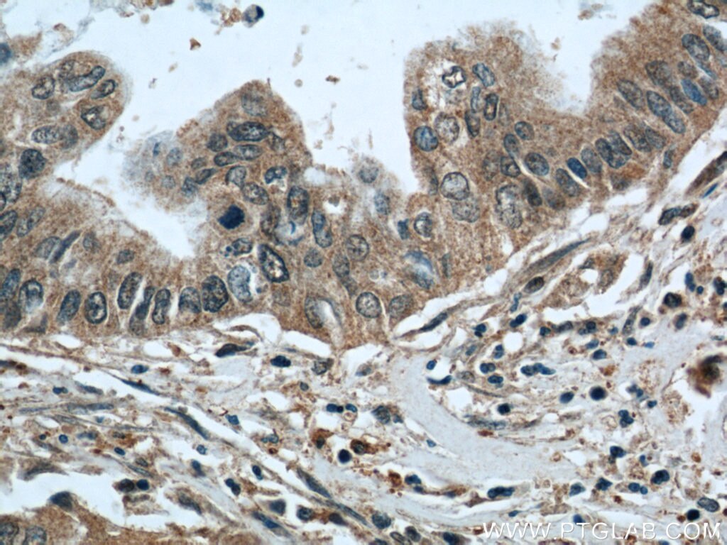 Immunohistochemistry (IHC) staining of human pancreas cancer tissue using RPL38 Polyclonal antibody (15055-1-AP)