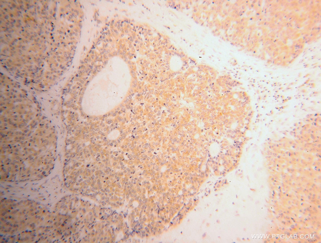 Immunohistochemistry (IHC) staining of human liver cancer tissue using RPL39 Polyclonal antibody (14990-1-AP)