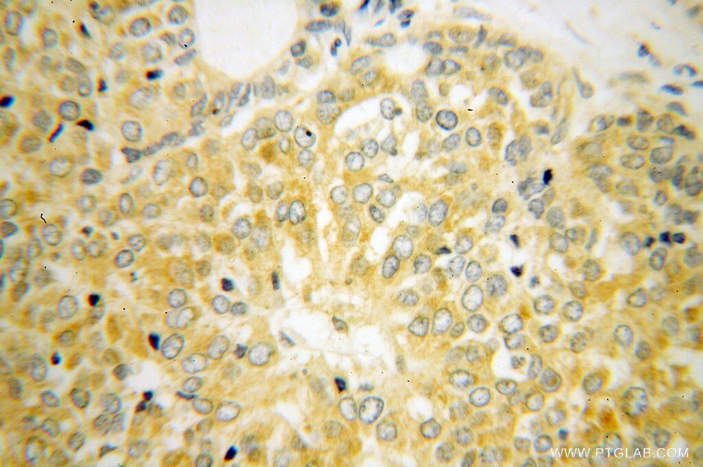 Immunohistochemistry (IHC) staining of human liver cancer tissue using RPL39 Polyclonal antibody (14990-1-AP)