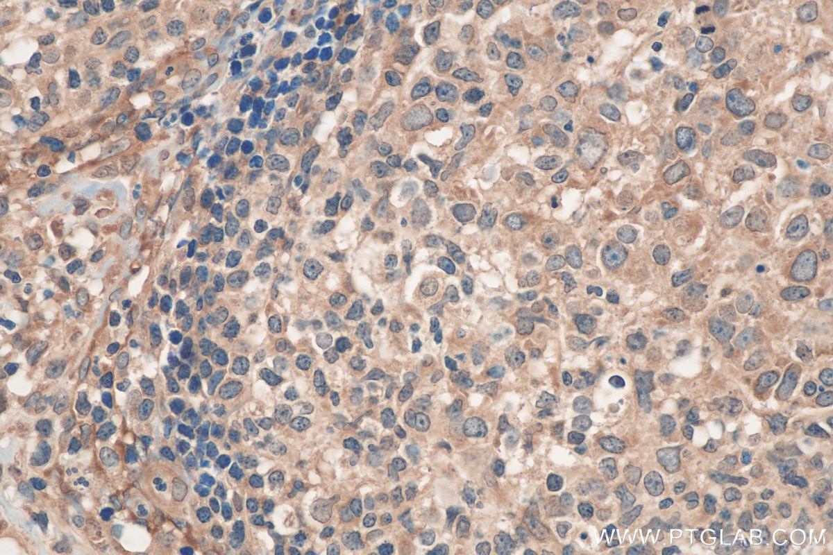 Immunohistochemistry (IHC) staining of human lymphoma tissue using Ribosomal protein L4 Polyclonal antibody (11302-1-AP)