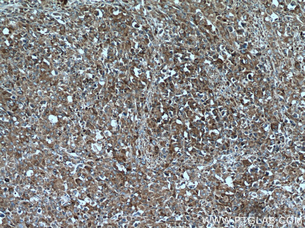 Immunohistochemistry (IHC) staining of human lymphoma tissue using Ribosomal protein L4 Monoclonal antibody (67028-1-Ig)