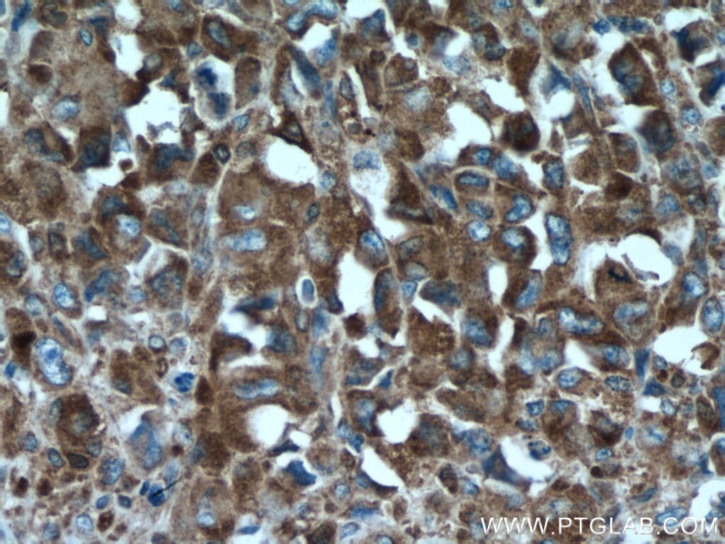 Immunohistochemistry (IHC) staining of human lymphoma tissue using Ribosomal protein L4 Monoclonal antibody (67028-1-Ig)