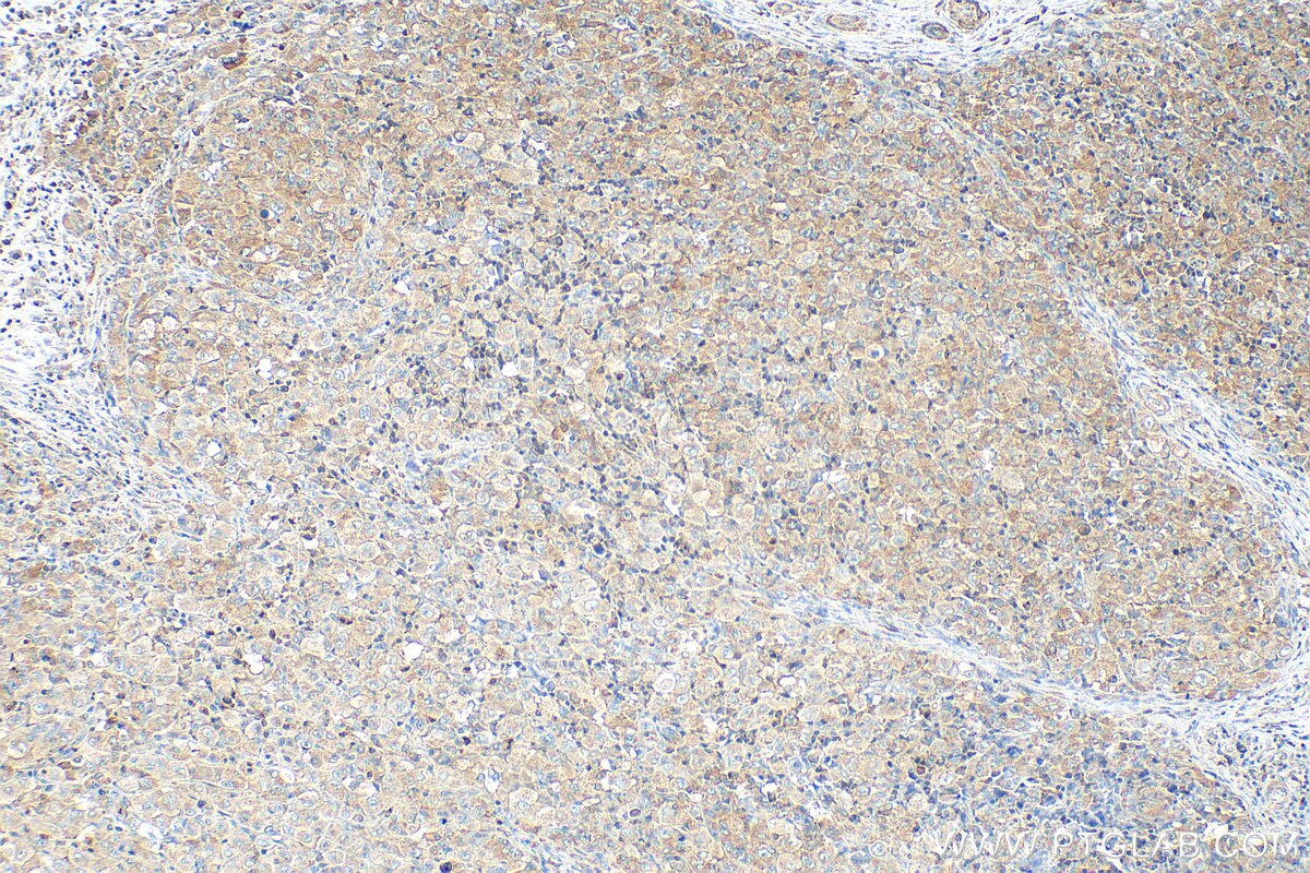 IHC staining of human lymphoma using 67028-1-Ig