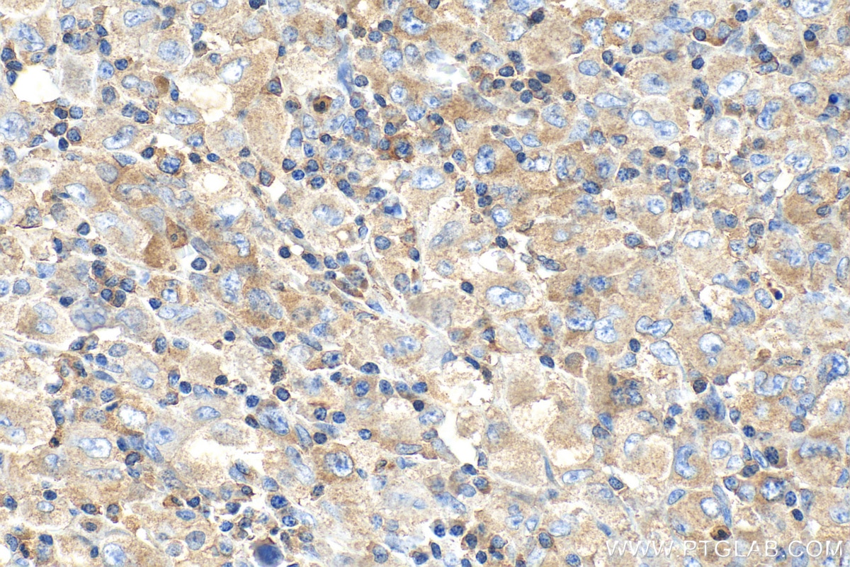 Immunohistochemistry (IHC) staining of human lymphoma tissue using Ribosomal protein L4 Monoclonal antibody (67028-1-Ig)