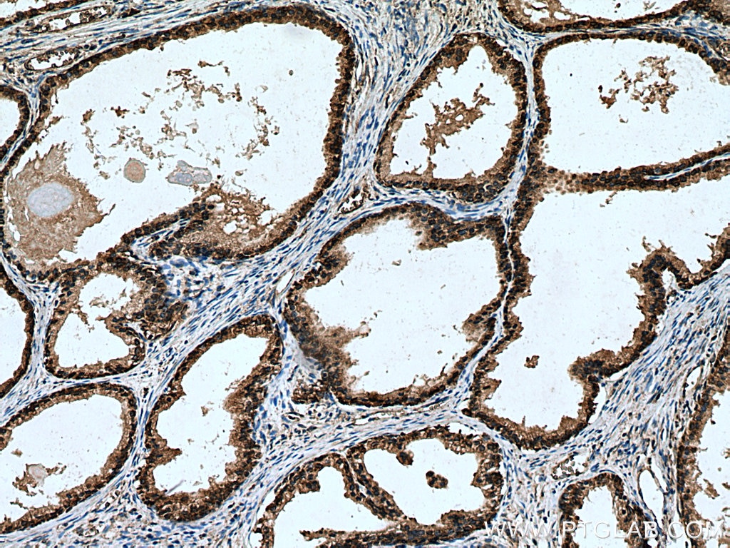 Immunohistochemistry (IHC) staining of human prostate cancer tissue using RPL5 Polyclonal antibody (29092-1-AP)