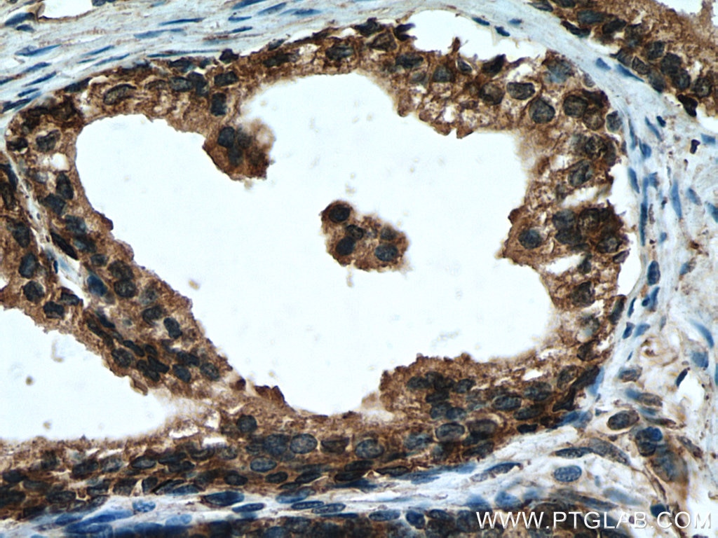 Immunohistochemistry (IHC) staining of human prostate cancer tissue using RPL5 Polyclonal antibody (29092-1-AP)