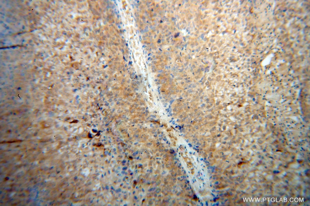 Immunohistochemistry (IHC) staining of human skin cancer tissue using RPL7 Polyclonal antibody (14583-1-AP)