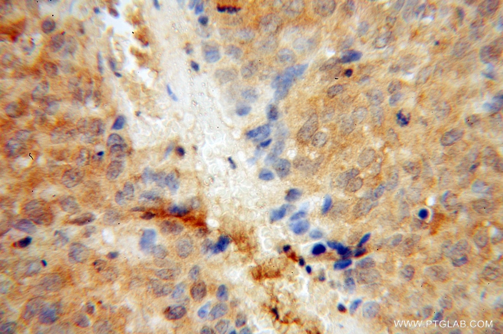 Immunohistochemistry (IHC) staining of human skin cancer tissue using RPL7 Polyclonal antibody (14583-1-AP)