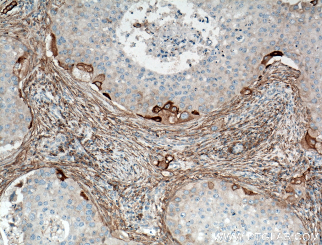 Immunohistochemistry (IHC) staining of human breast cancer tissue using RPL7A Polyclonal antibody (15340-1-AP)