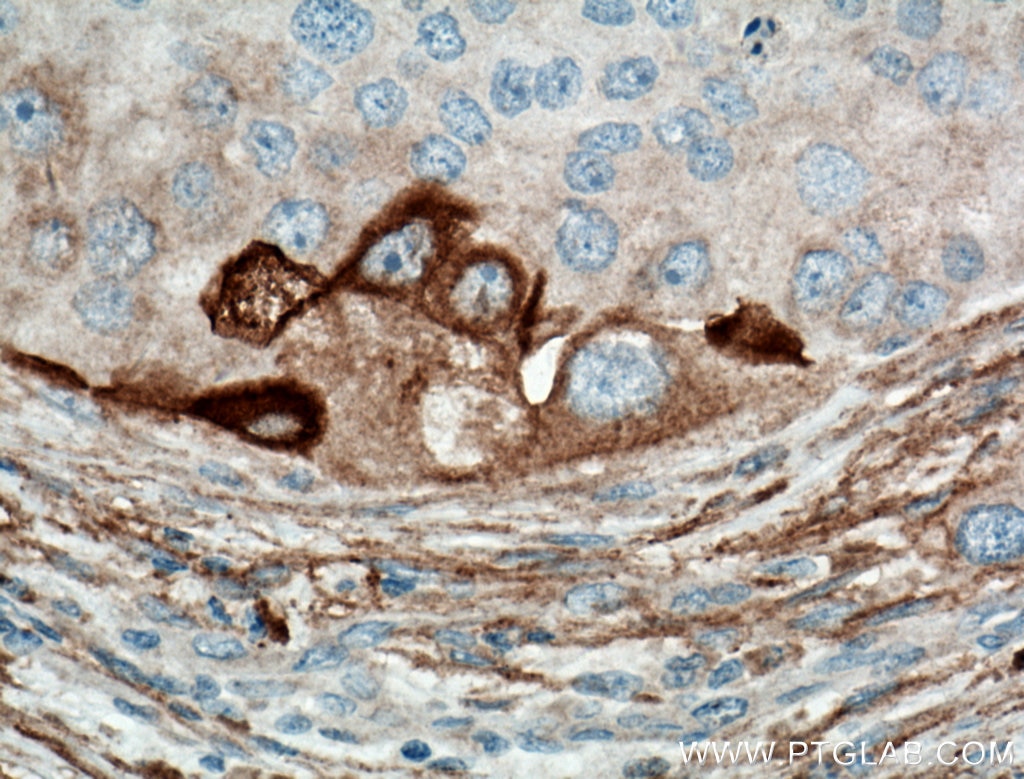 IHC staining of human breast cancer using 15340-1-AP