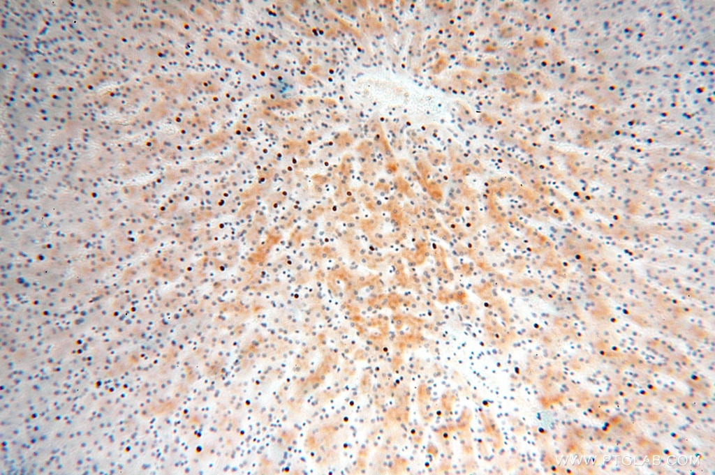 Immunohistochemistry (IHC) staining of human liver cancer tissue using RPL7L1 Polyclonal antibody (16707-1-AP)