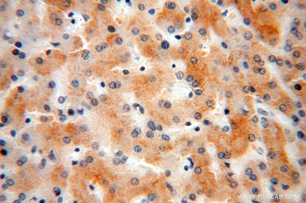 Immunohistochemistry (IHC) staining of human liver cancer tissue using RPL7L1 Polyclonal antibody (16707-1-AP)