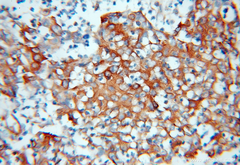 Immunohistochemistry (IHC) staining of human colon cancer tissue using RPLP0 Polyclonal antibody (11290-2-AP)