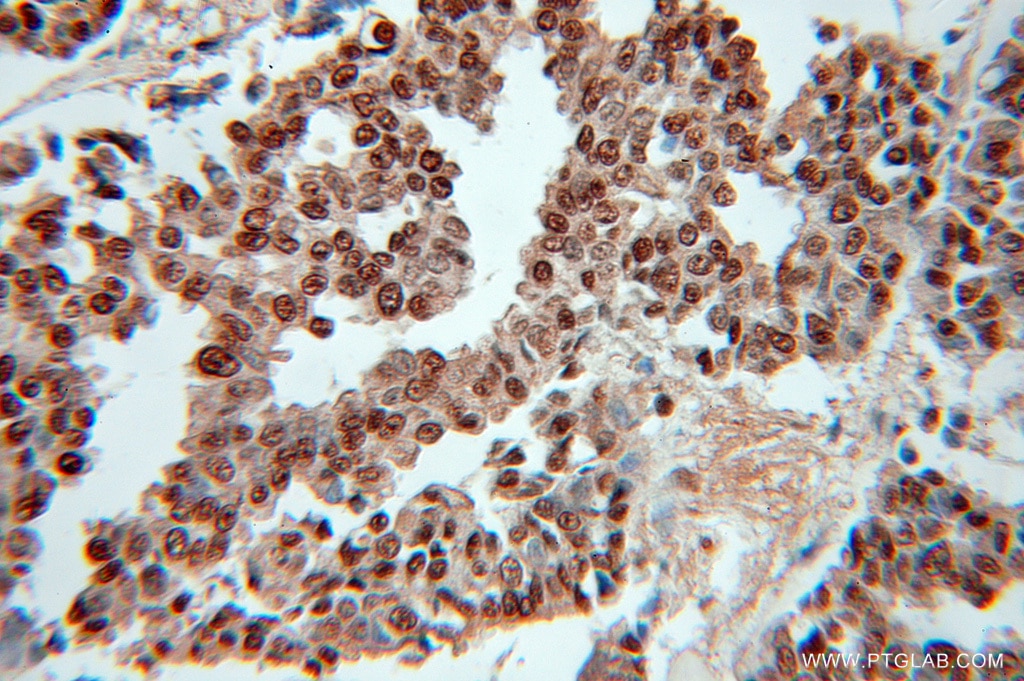 Immunohistochemistry (IHC) staining of human breast cancer tissue using RPLP0 Polyclonal antibody (51019-2-AP)
