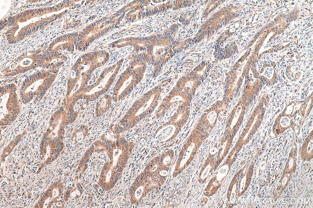 Immunohistochemistry (IHC) staining of human colon cancer tissue using RPLP0 Monoclonal antibody (68056-1-Ig)