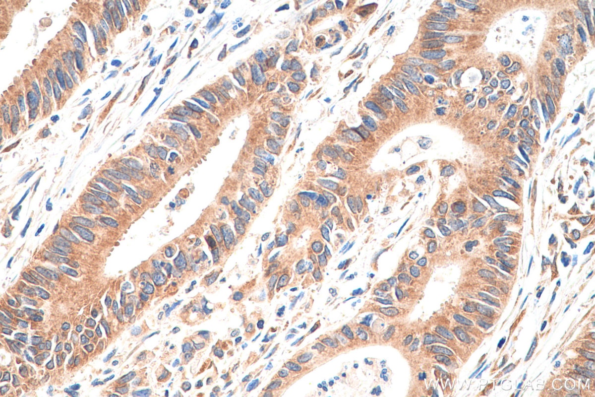 Immunohistochemistry (IHC) staining of human colon cancer tissue using RPLP0 Monoclonal antibody (68056-1-Ig)