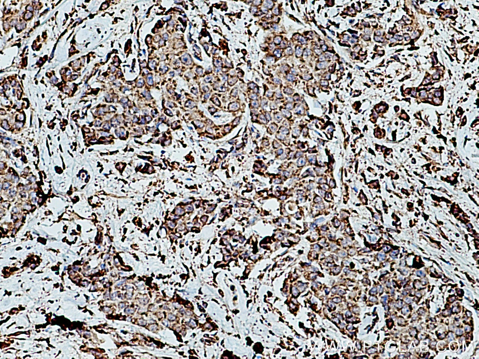 Immunohistochemistry (IHC) staining of human breast cancer tissue using RPLP2 Polyclonal antibody (16805-1-AP)