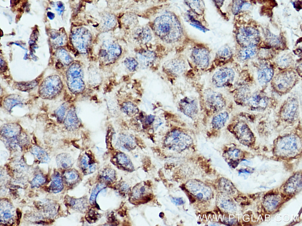 Immunohistochemistry (IHC) staining of human breast cancer tissue using RPLP2 Polyclonal antibody (16805-1-AP)