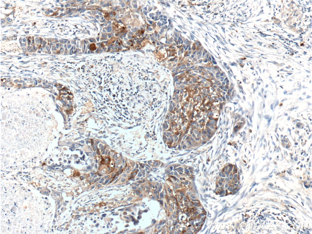 Immunohistochemistry (IHC) staining of human lung cancer tissue using RPN2 Polyclonal antibody (10576-1-AP)