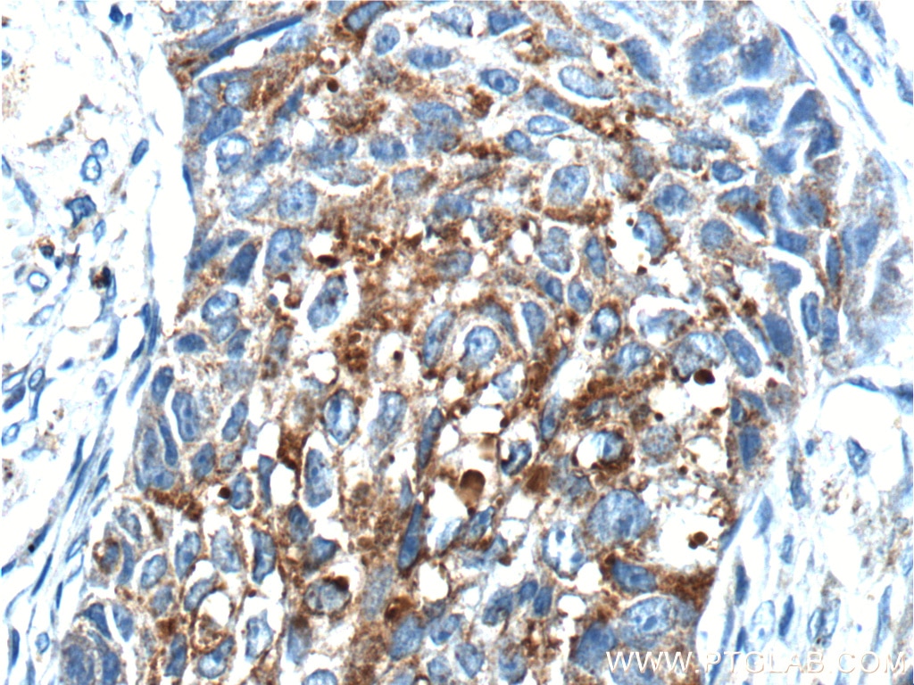 Immunohistochemistry (IHC) staining of human lung cancer tissue using RPN2 Polyclonal antibody (10576-1-AP)