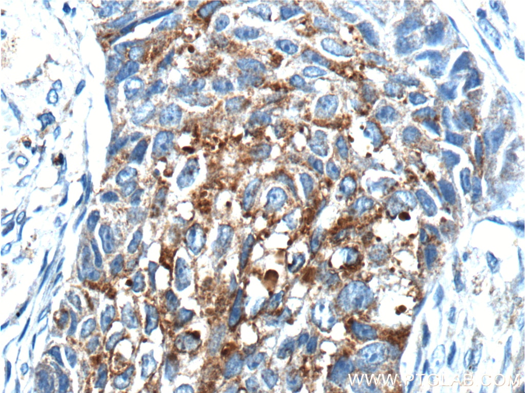 IHC staining of human lung cancer using 10576-1-AP