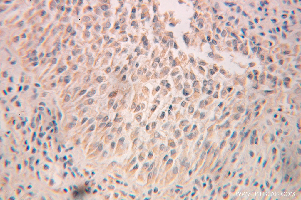 Immunohistochemistry (IHC) staining of human ovary tumor tissue using RPN2 Polyclonal antibody (10576-1-AP)