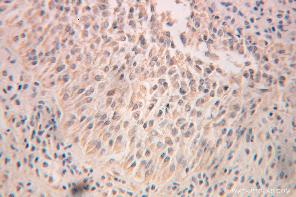 IHC staining of human ovary tumor using 10576-1-AP