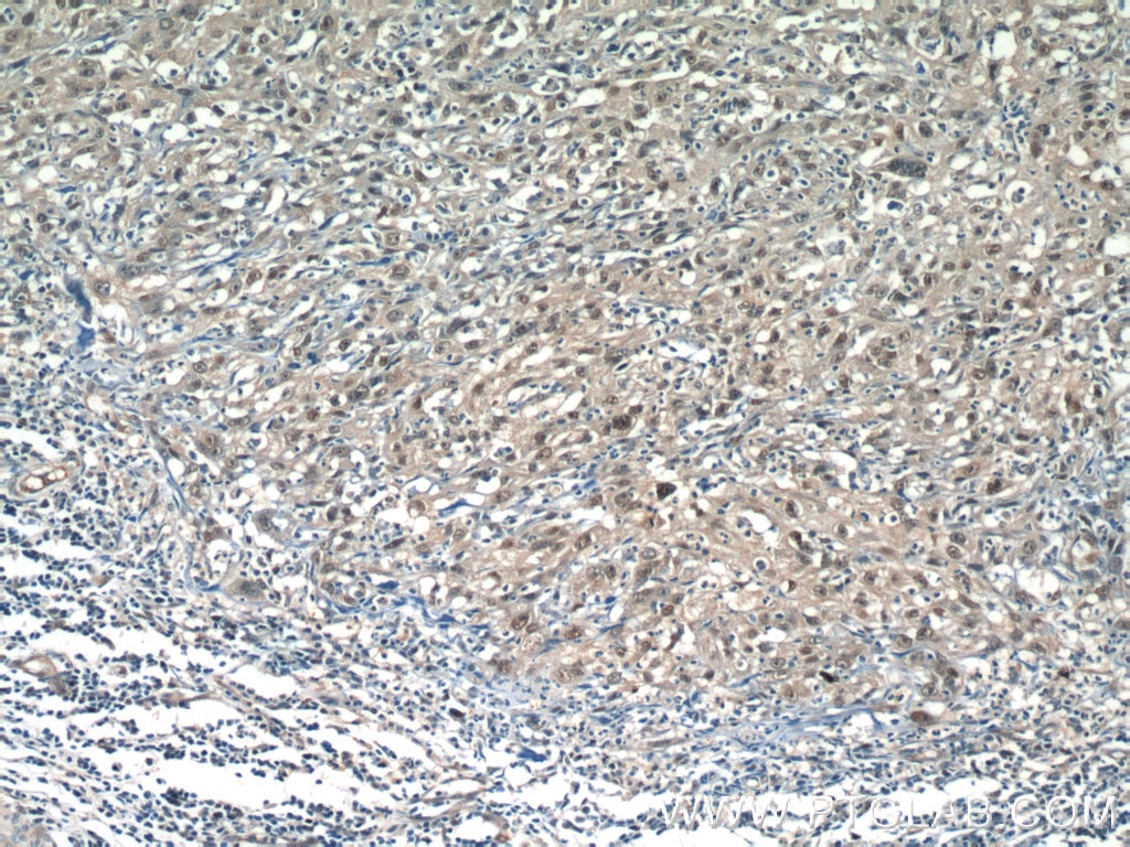 Immunohistochemistry (IHC) staining of human cervical cancer tissue using RPP25 Polyclonal antibody (15461-1-AP)